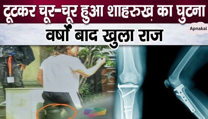 Shahrukh Khan's knee is ruined due to wear and tear, condition will make you cry