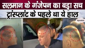 You will not believe the truth of Salman Khan's hair transplant, seeing the condition