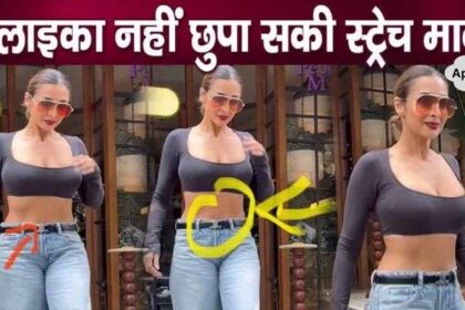 Stretch mark clearly visible on Malaika Arora's stomach, this condition happened due to cesarean delivery