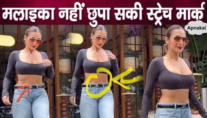 Stretch mark clearly visible on Malaika Arora's stomach, this condition happened due to cesarean delivery